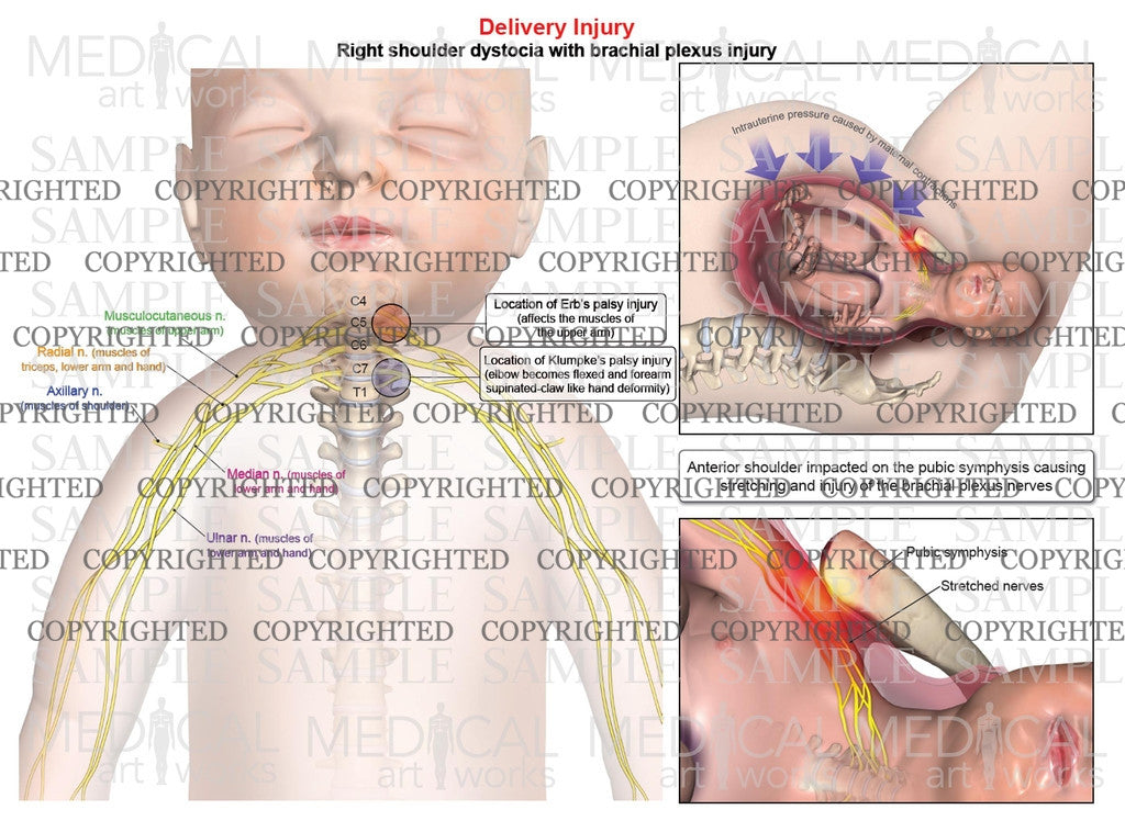 Right shoulder dystocia with brachial plexus injury