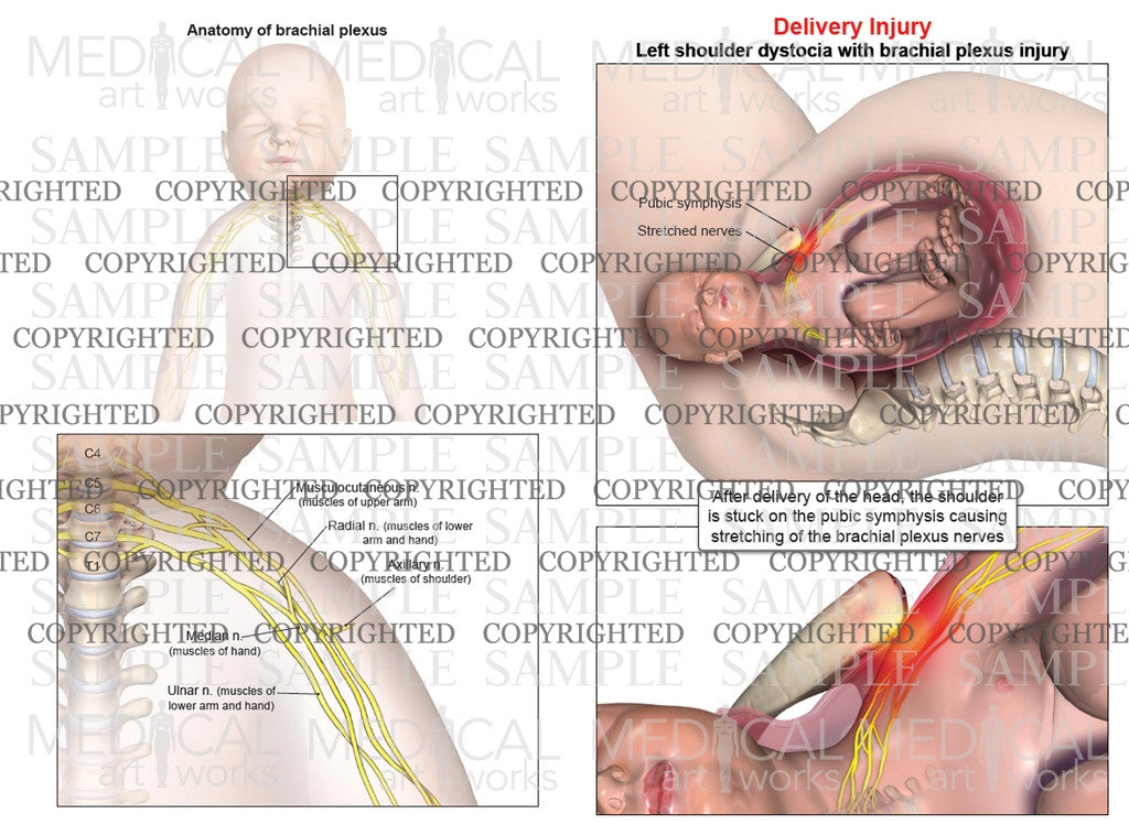 Left anterior shoulder dystocia