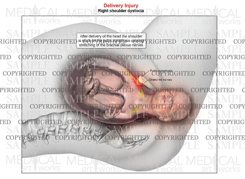 Right anterior shoulder dystocia (single image)