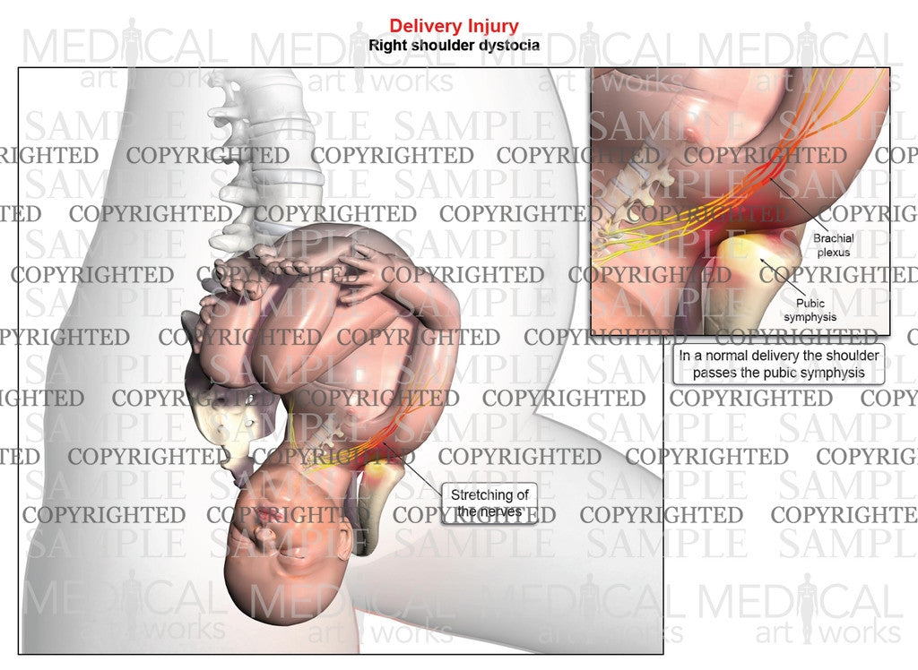 Right anterior shoulder dystocia, vertical
