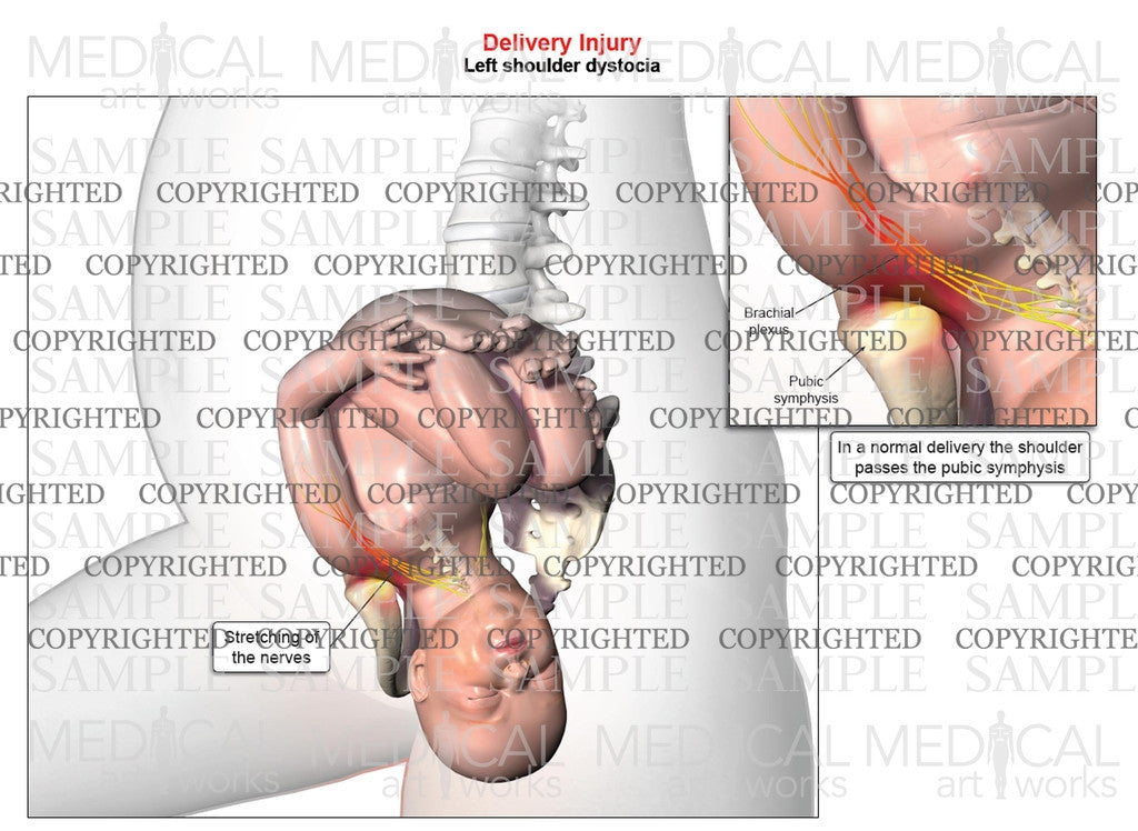 Left anterior shoulder dystocia, vertical
