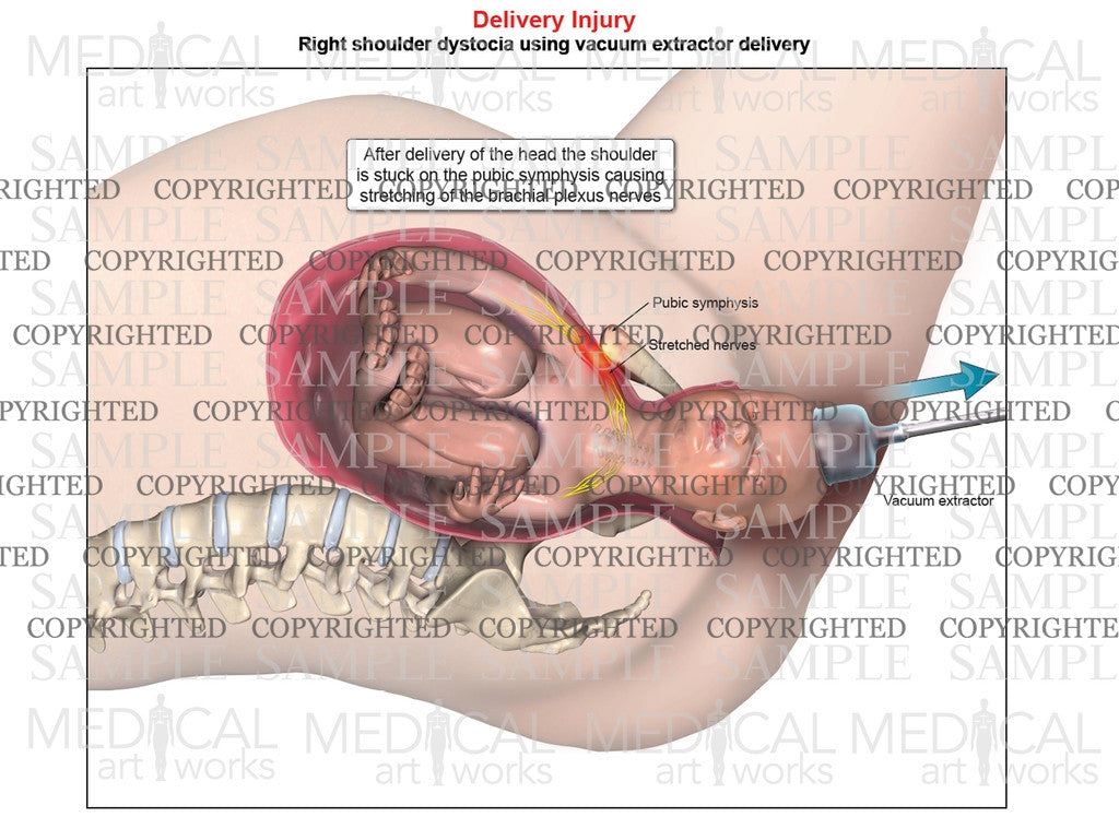 Right anterior shoulder dystocia with vacuum assistance