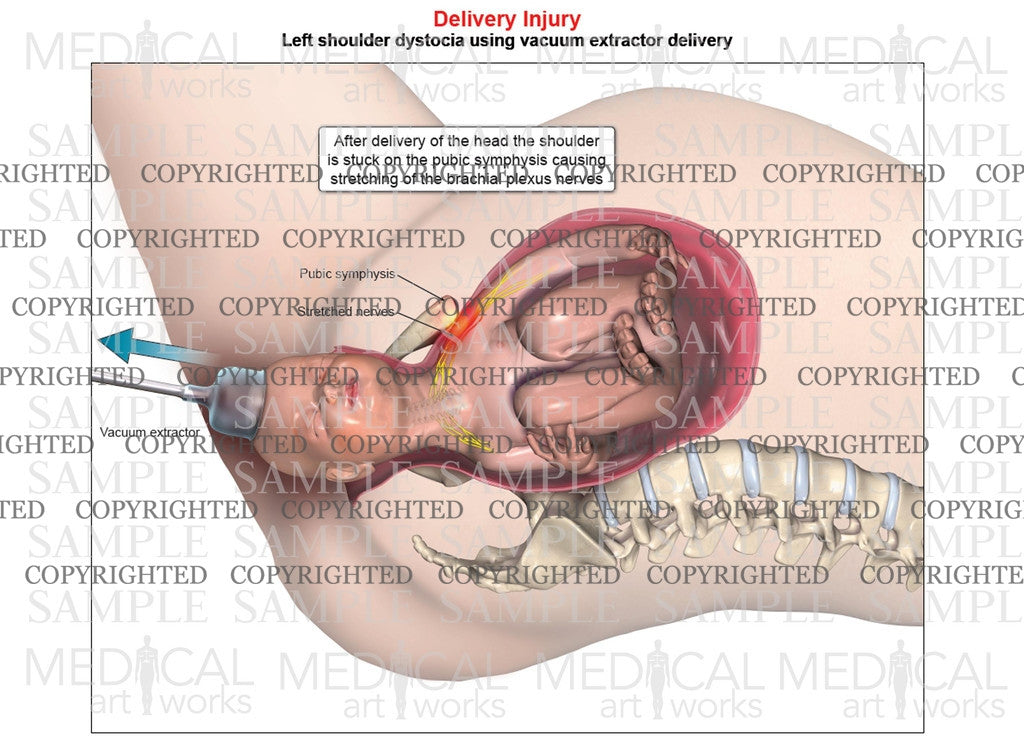 Left anterior shoulder dystocia with vacuum assistance