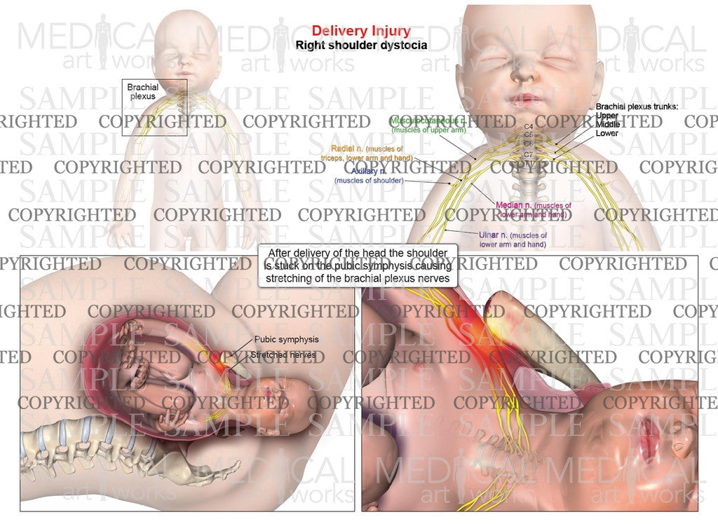 Right anterior shoulder dystocia, brachial plexus anatomy