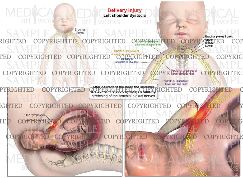 Left anterior shoulder dystocia, brachial plexus anatomy