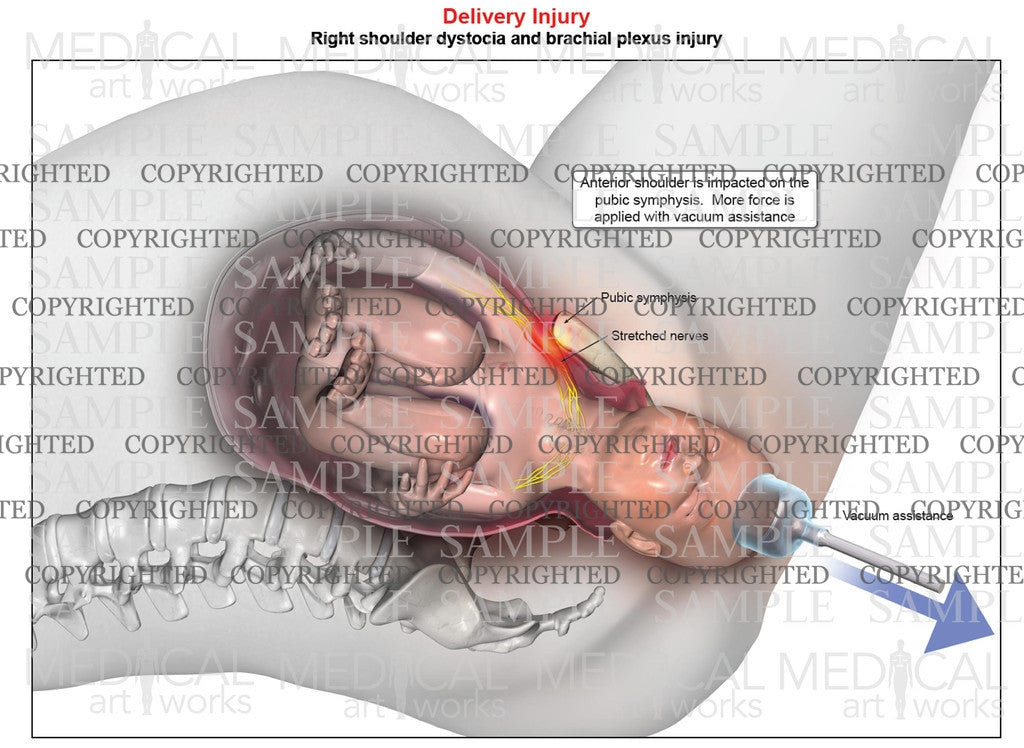 Right anterior shoulder dystocia with vacuum assistance. Single image