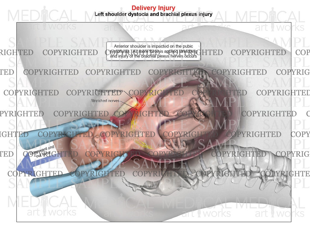 Left anterior shoulder dystocia with downward force assistance