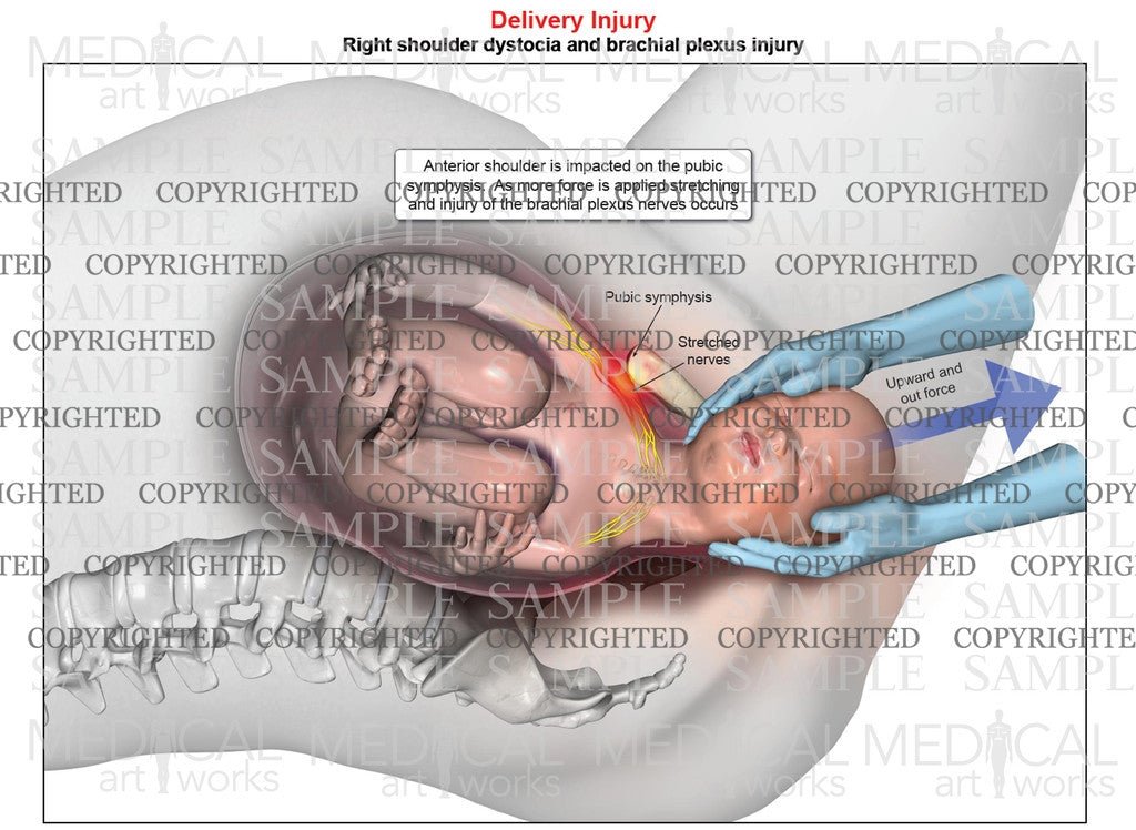 Right anterior shoulder dystocia with upward force assistance