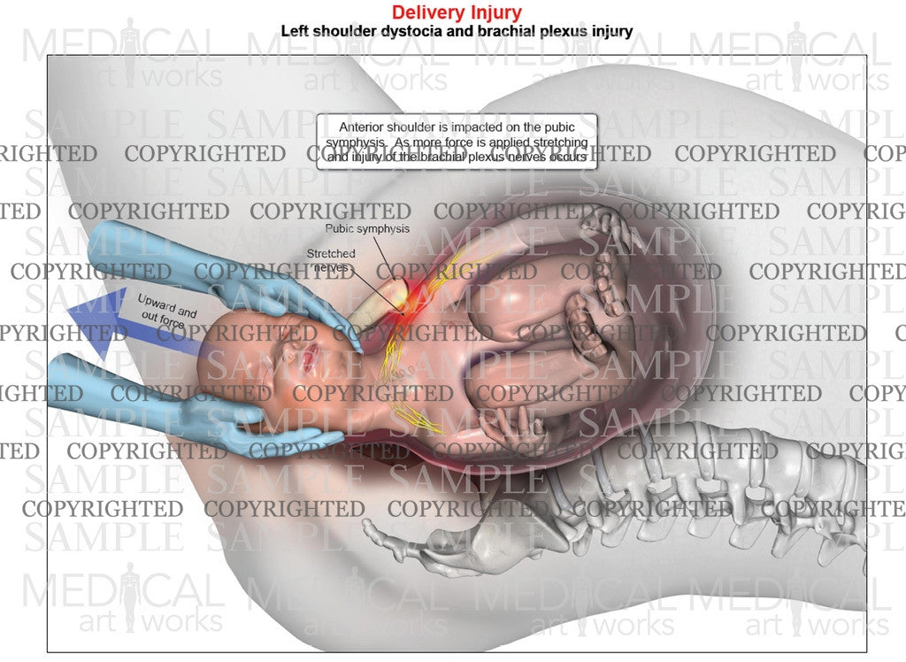 Left anterior shoulder dystocia with upward force assistance