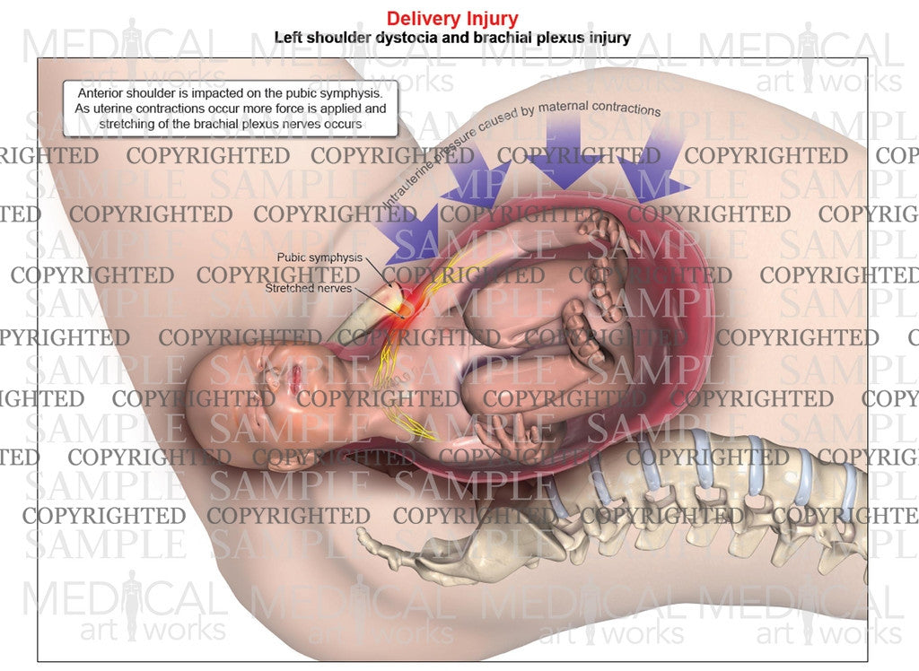 Left anterior shoulder dystocia with maternal contractions