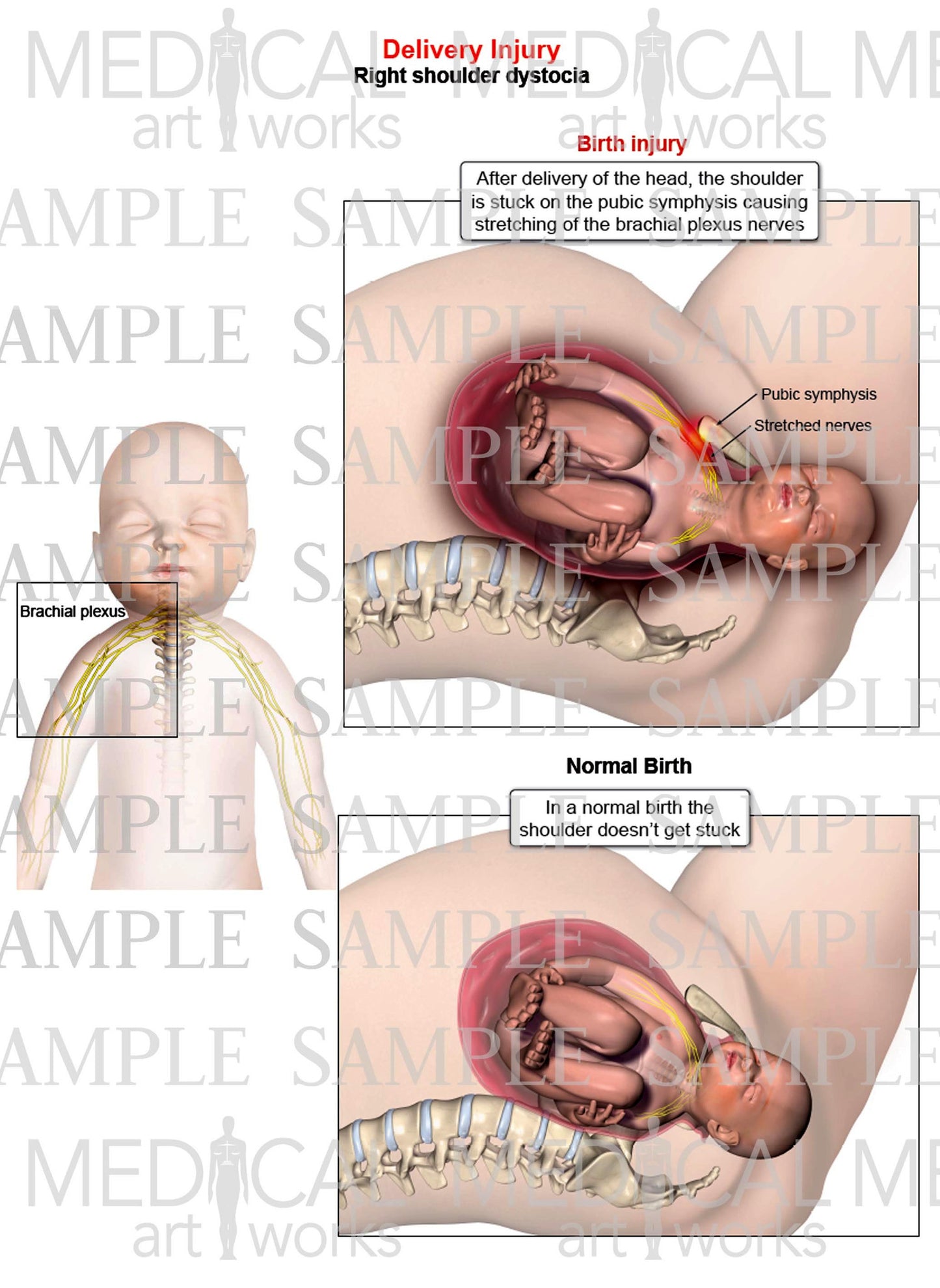 Right shoulder dystocia with brachial plexus injury
