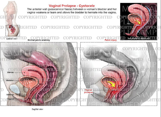 Vaginal Prolapse - Cystocele and Normal comparison