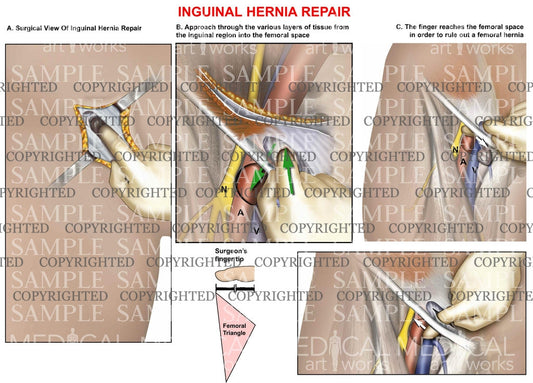 Inguinal hernia repair