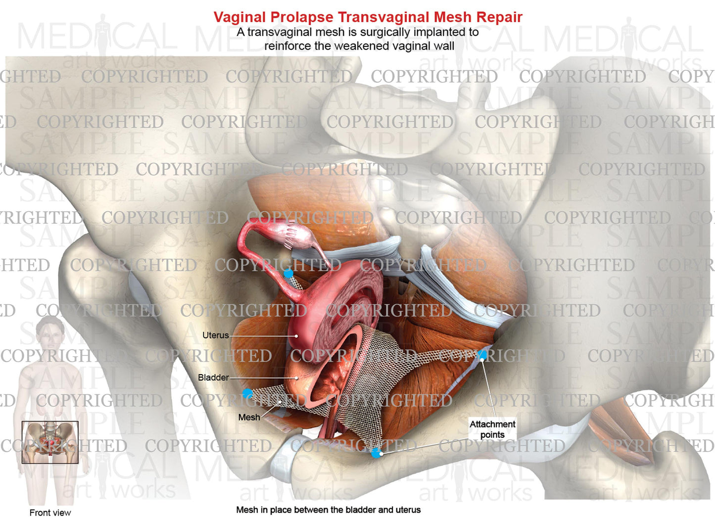 Transvaginal Mesh Device