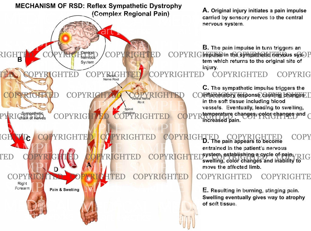 MECHANISM OF RSD: Reflex Sympathetic Dystrophy (Complex Regional Pain)