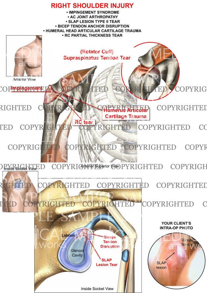 Right Shoulder Injury and trauma