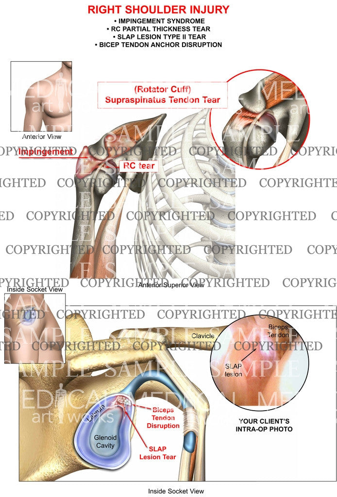 Right Shoulder RC, SLAP tears+impingement