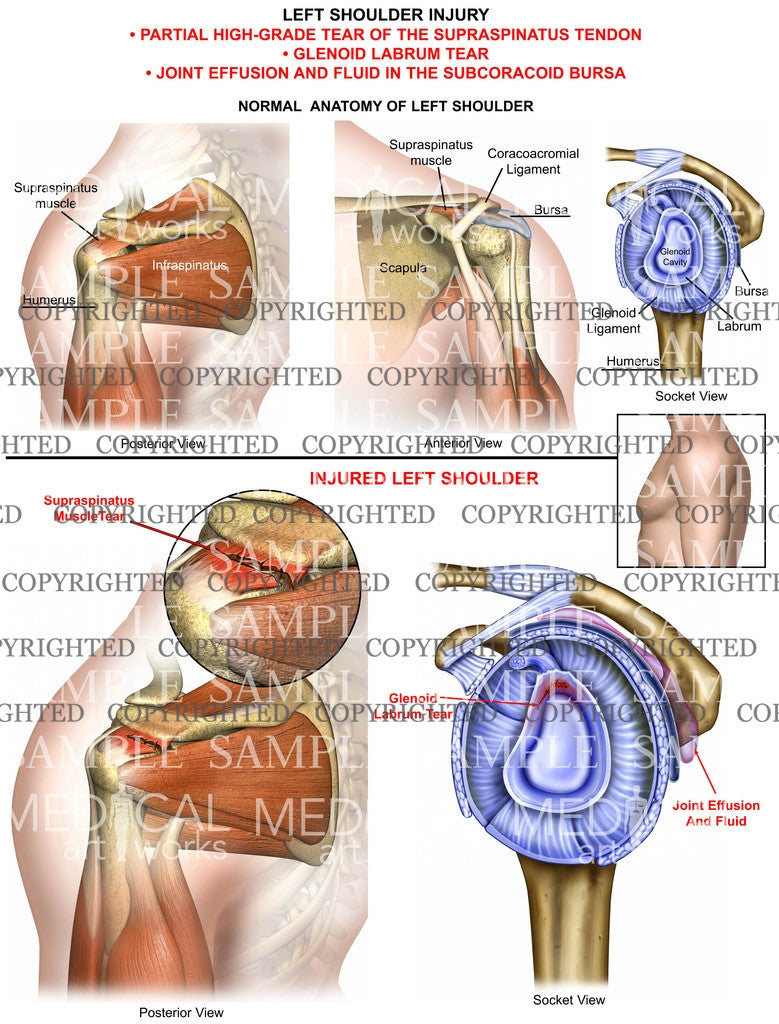 Left shoulder injury and tear