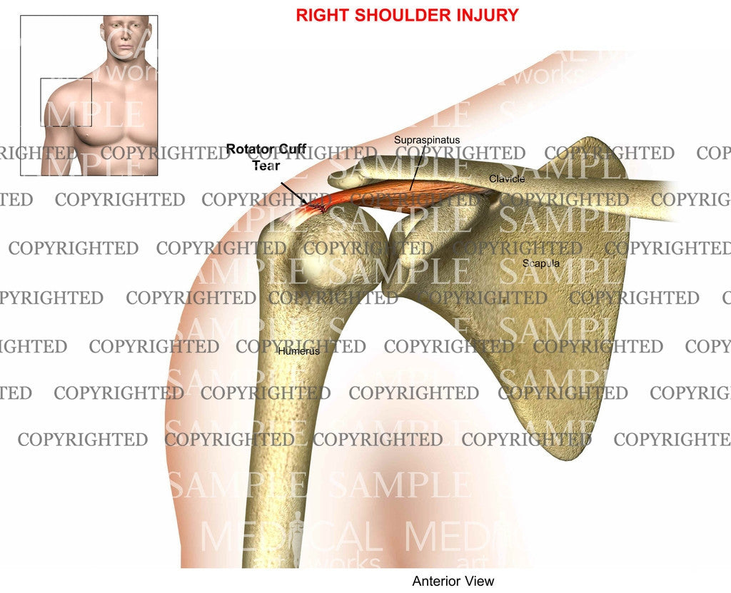 RC partial tear