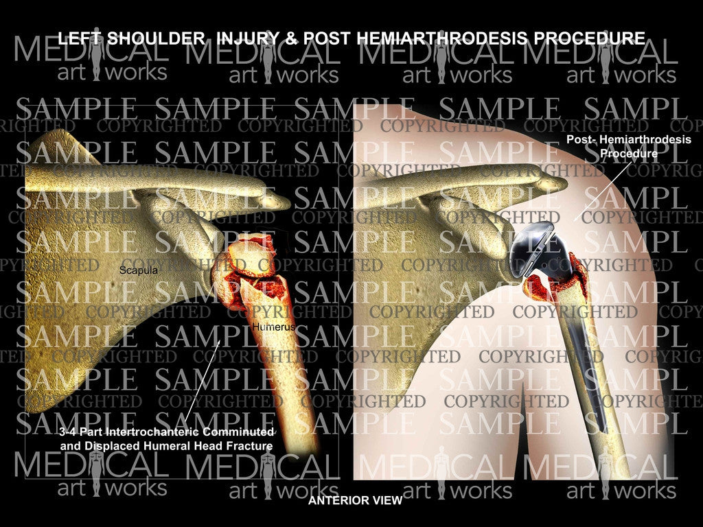 Left Shoulder Injury & Post- Surgical Procedure