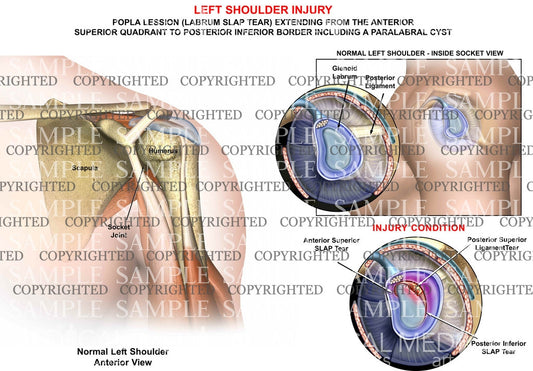 Injured left shoulder - Popla lesion