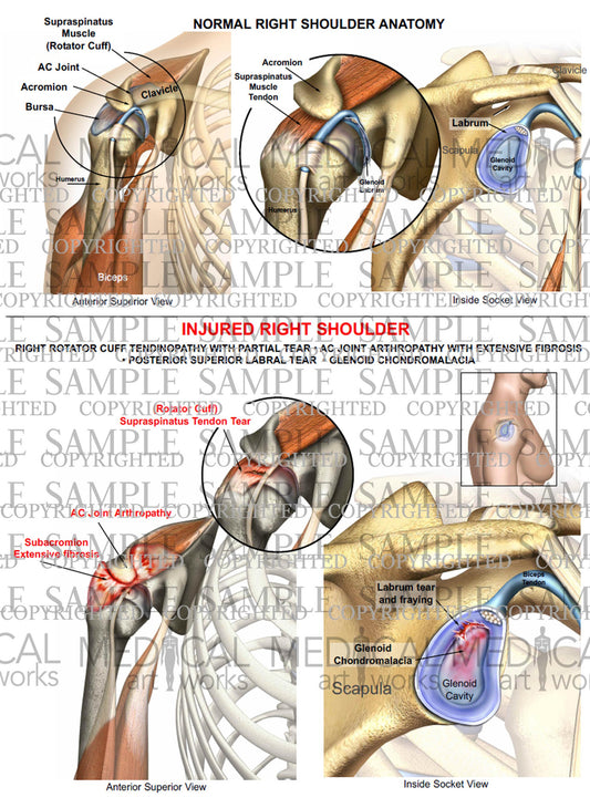 Right Shoulder RC tear - Labral tear - Chondromalacia