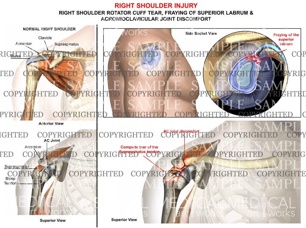 Right Shoulder injury with tear 2