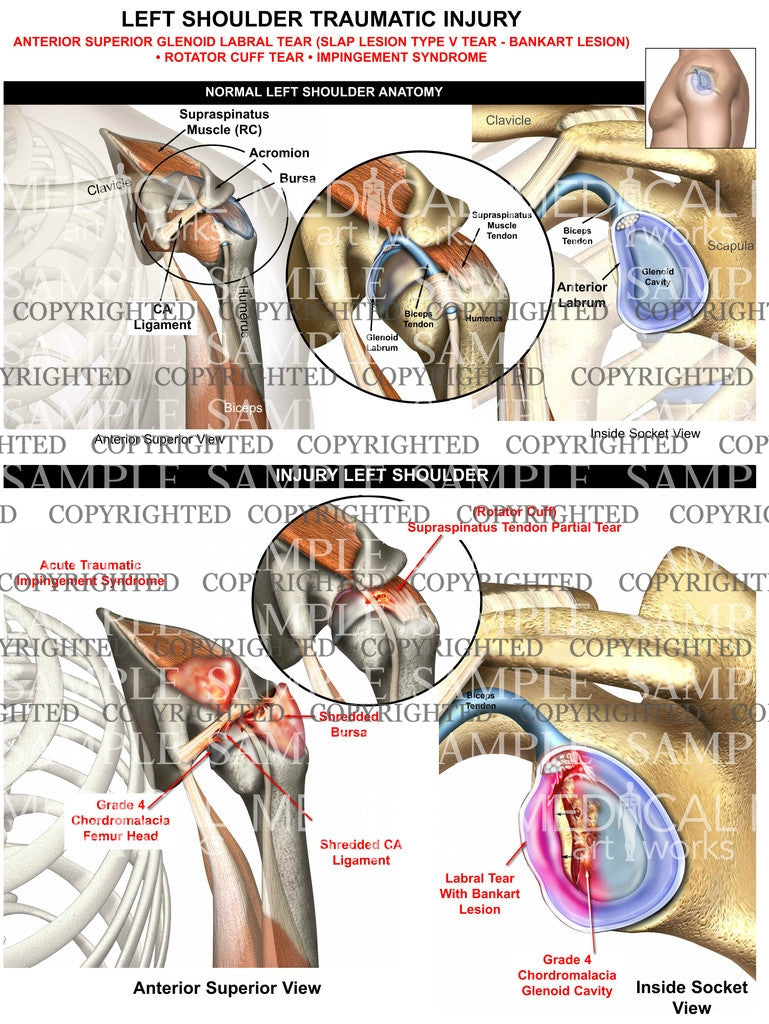 Left Shoulder traumatic Injury