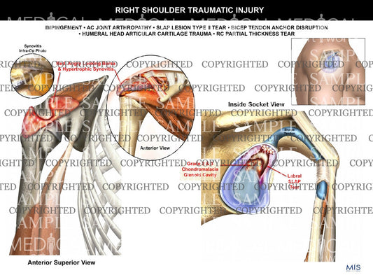 Right Shoulder traumatic Injury