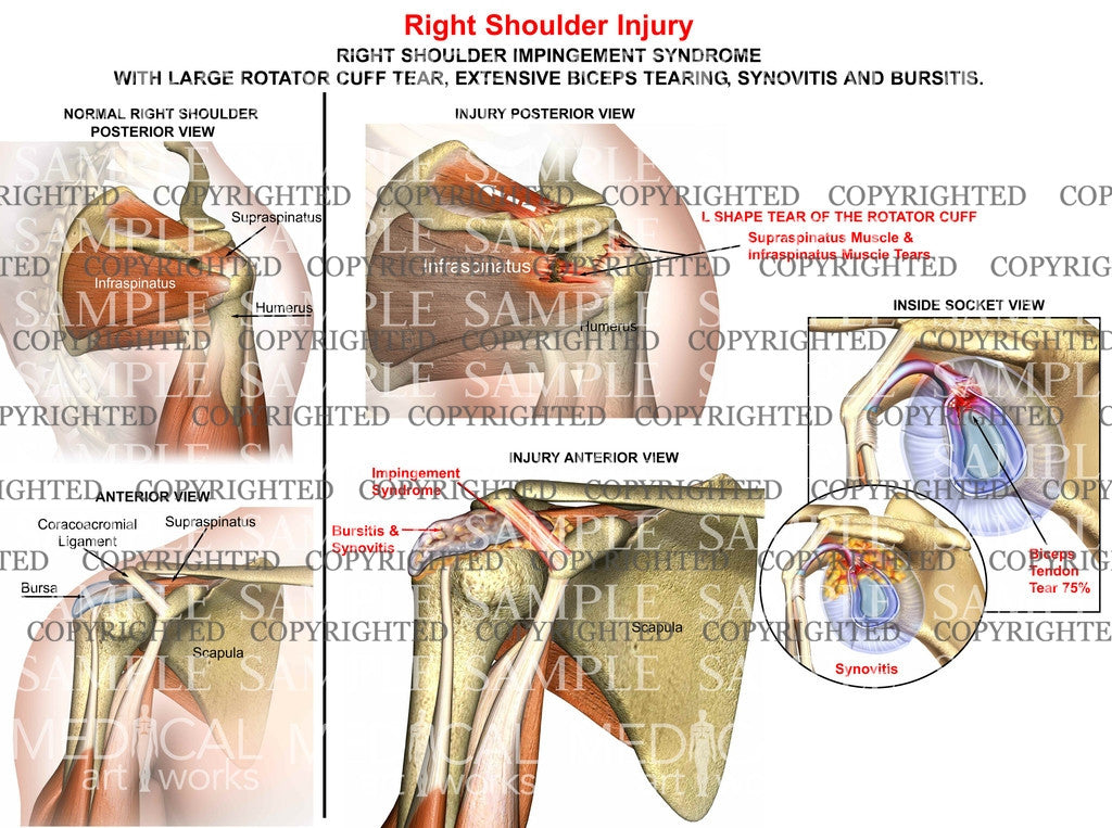 Right Shoulder injury with tear