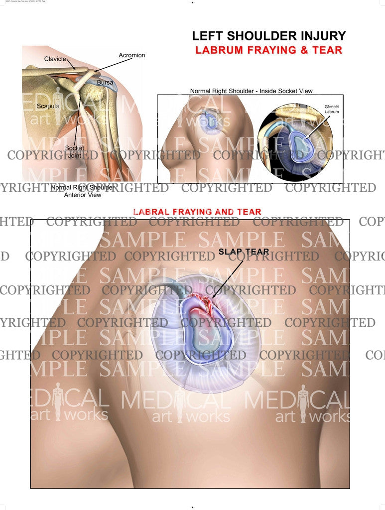 Left Shoulder injury 3