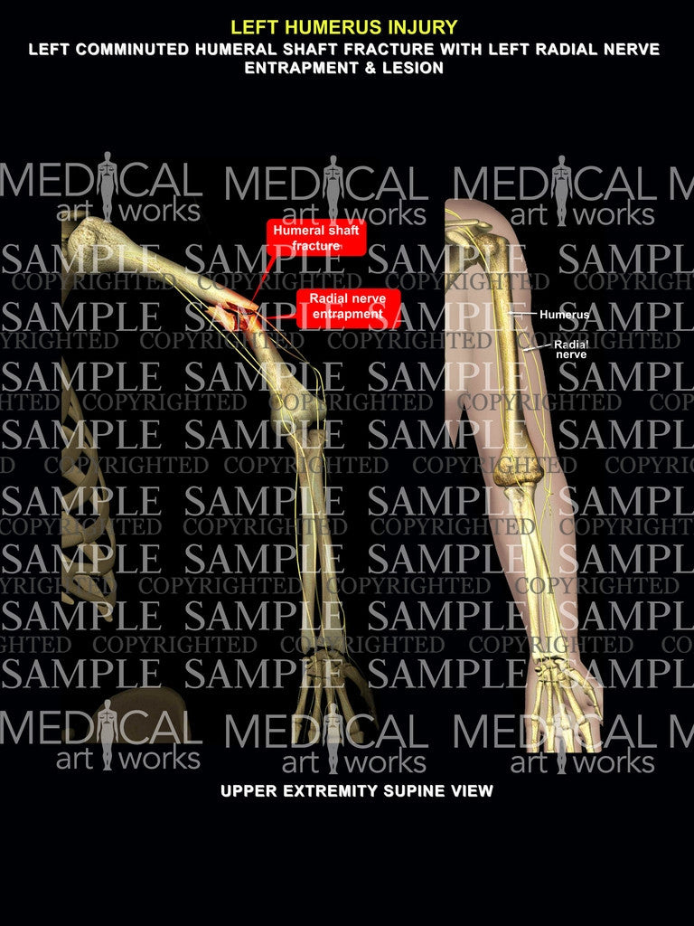 Left Shoulder injury 2