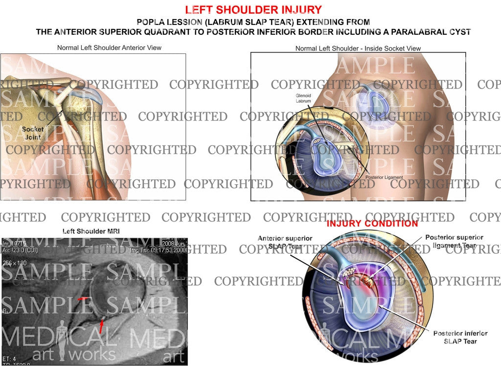 Labral SLAP tear - POPLA