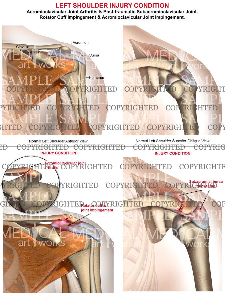 Left Shoulder injury 4