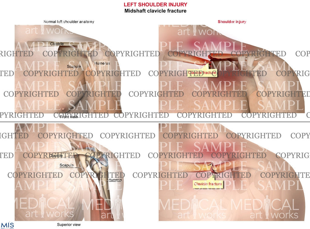 Left Shoulder injury 1