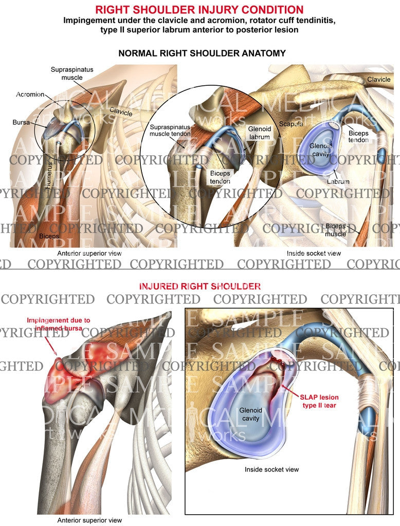 Right Shoulder impingement