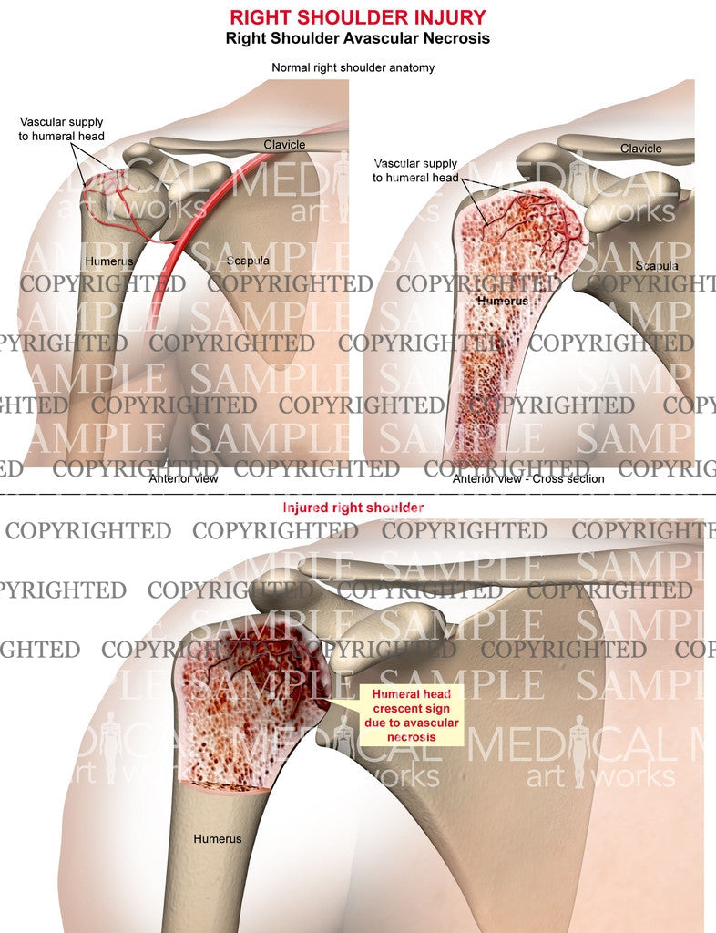 Right Shoulder Avascular Necrosis