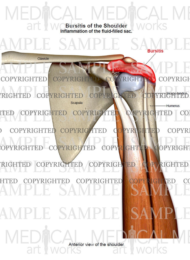 Bursitis of the shoulder