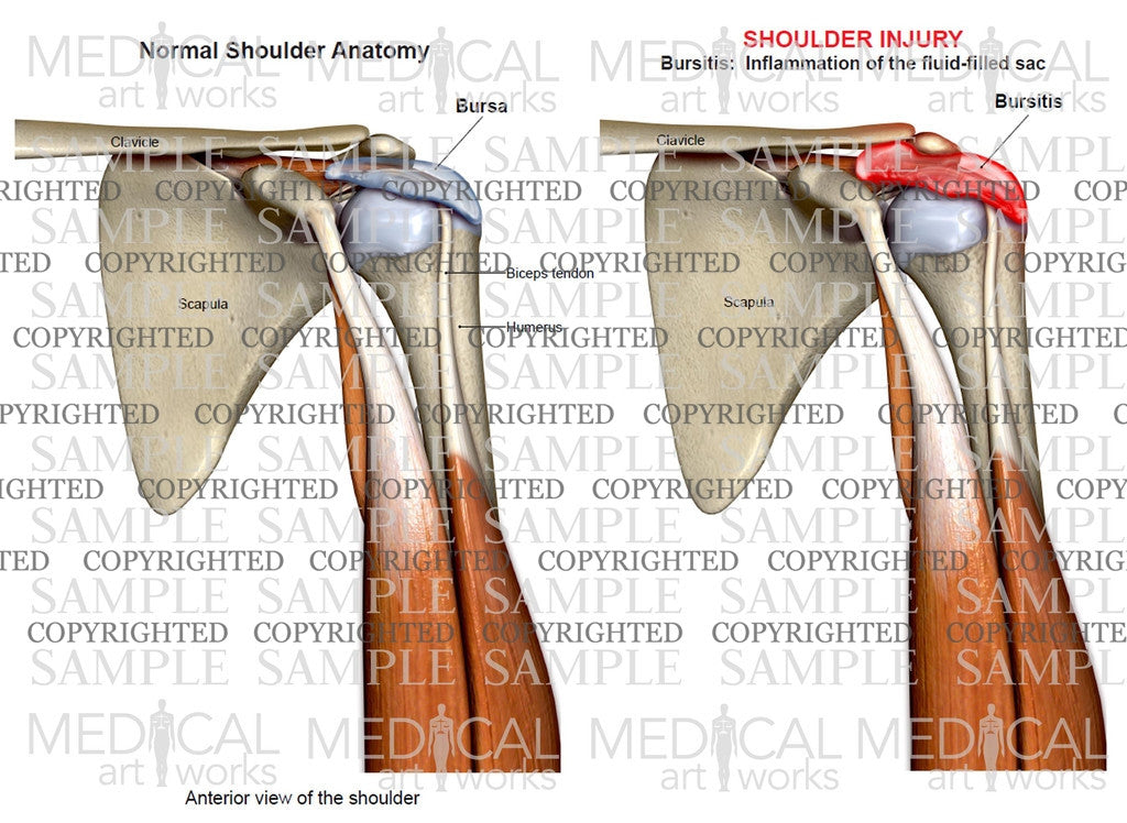 Shoulder bursitis+normal