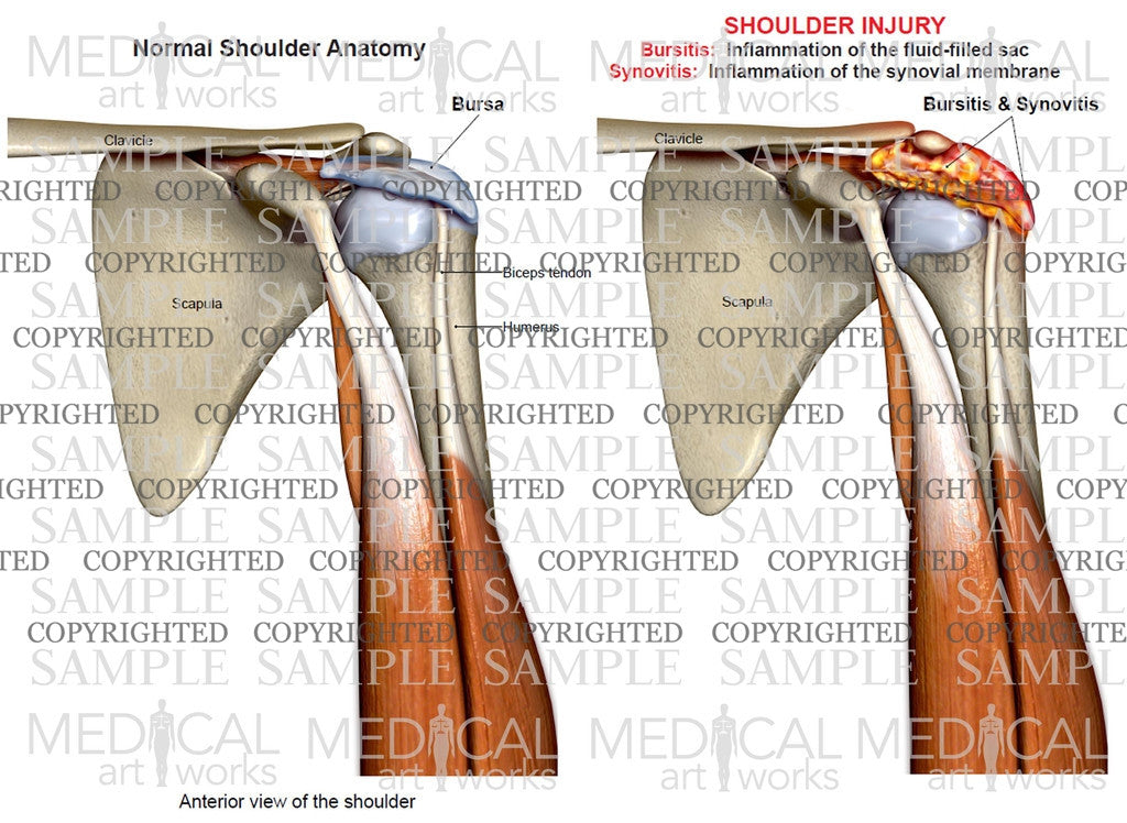 Shoulder synovitis, bursitis + normal