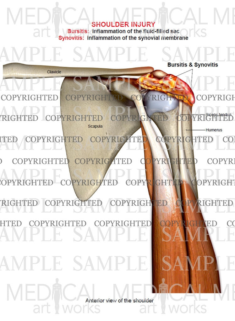 Synovitis & bursitis of the shoulder