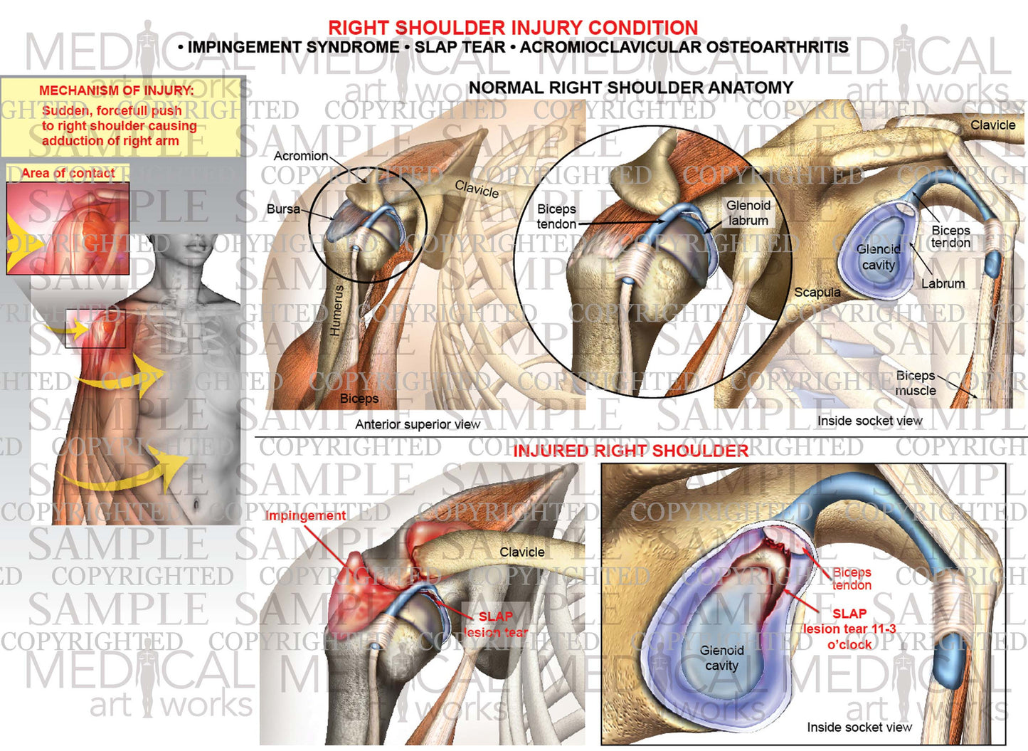 Labral SLAP tear - Right Shoulder injury