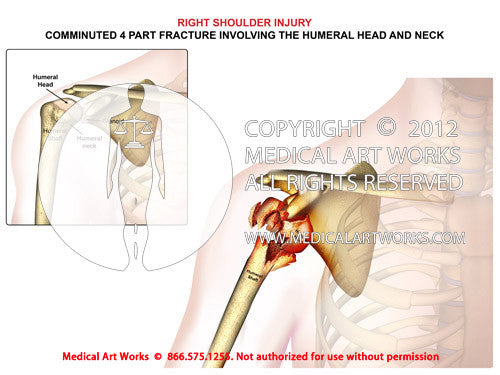Right shoulder fracture involving the humeral head and neck