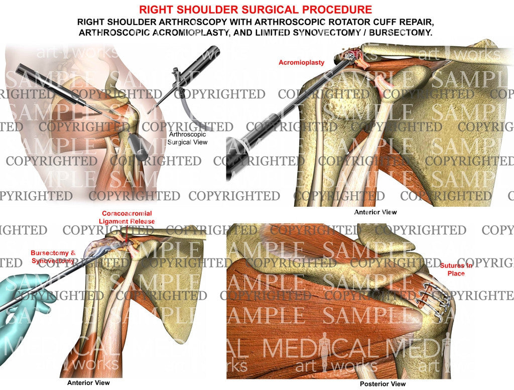 Shoulder Rotator Cuff Repair