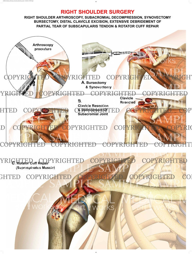 Arthroscopic surgery of right shoulder