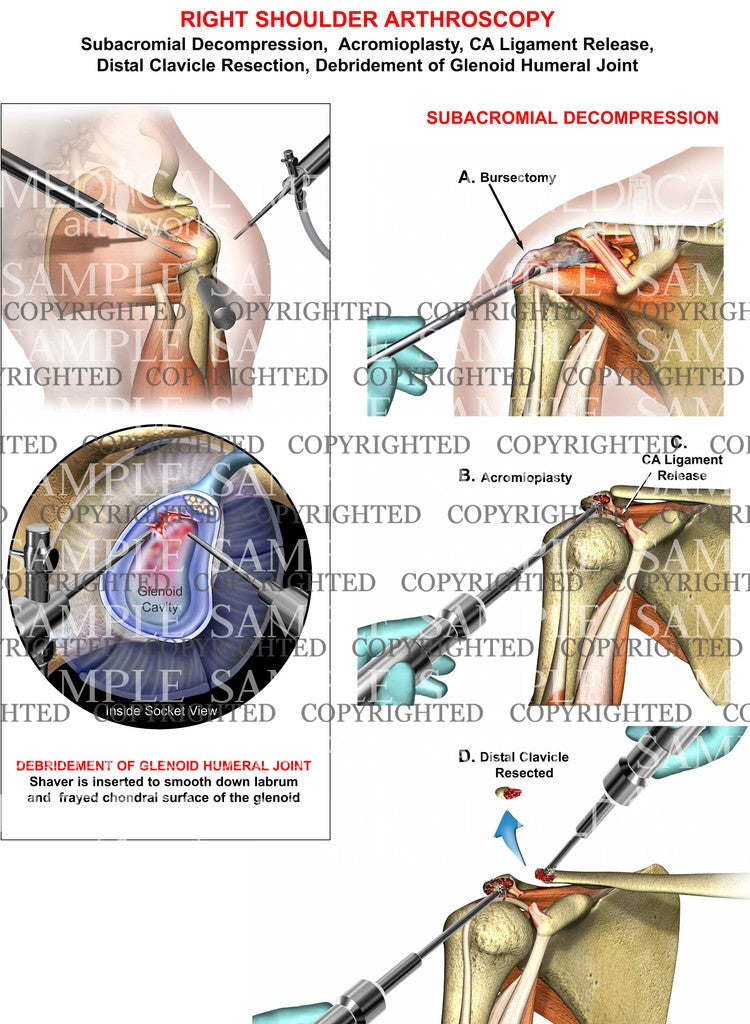 right shoulder arthroscopic procedures