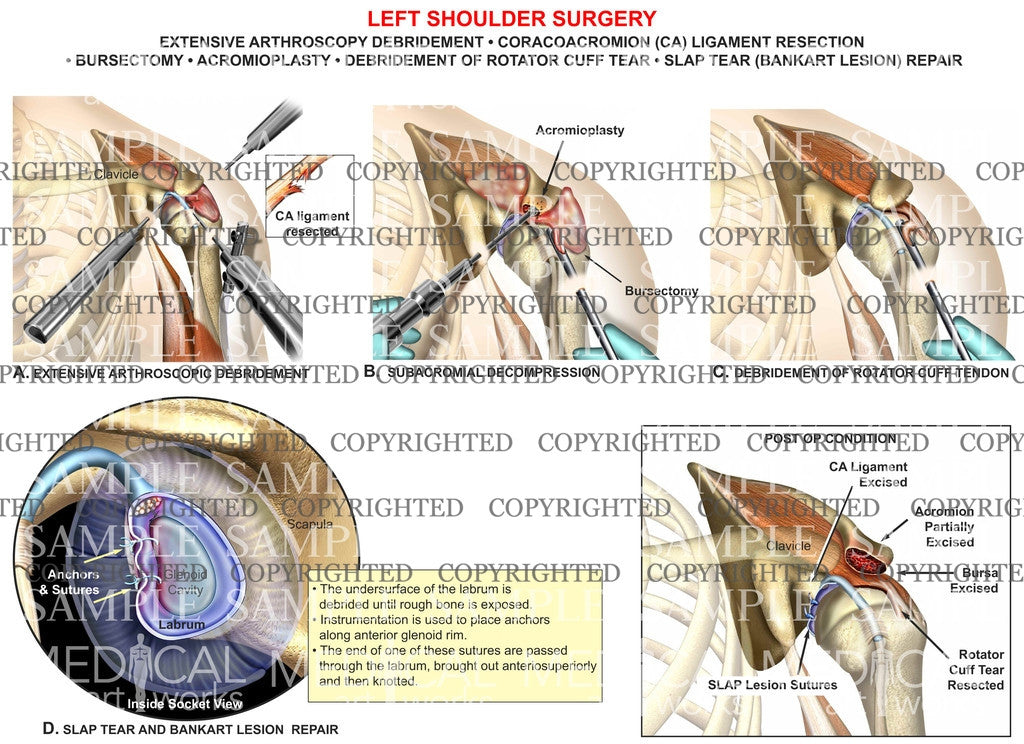 Left Shoulder extensive arthroscopy - Bursectomy - Acromioplasty