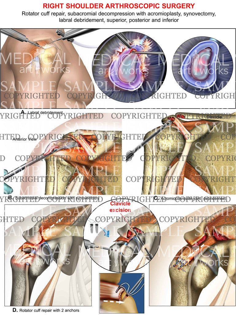 Right shoulder arthroscopic Surgery