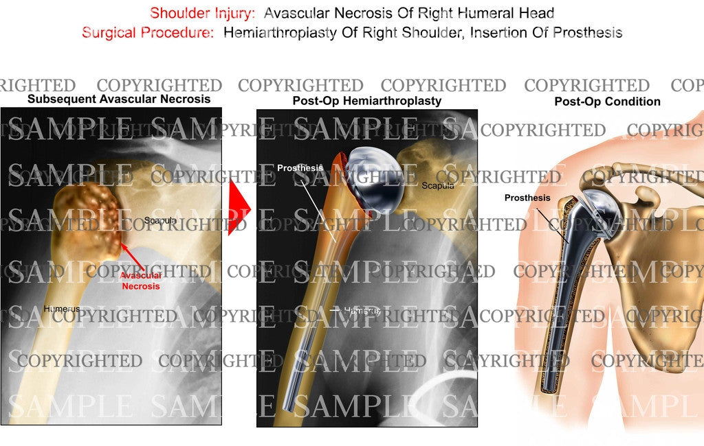 Hemiarthroplasty