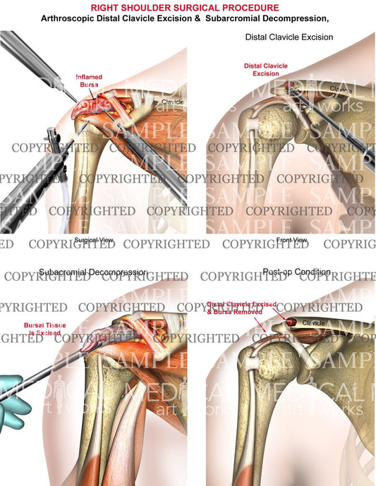 right shoulder Surgical Procedure 1